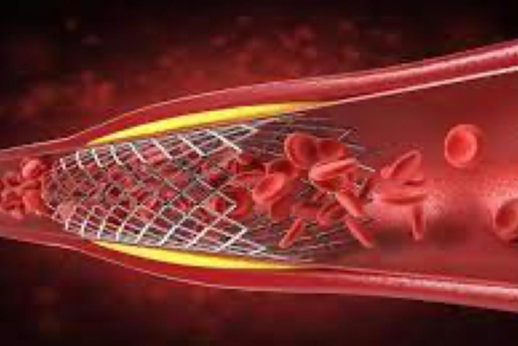 Al Extremity Stenting